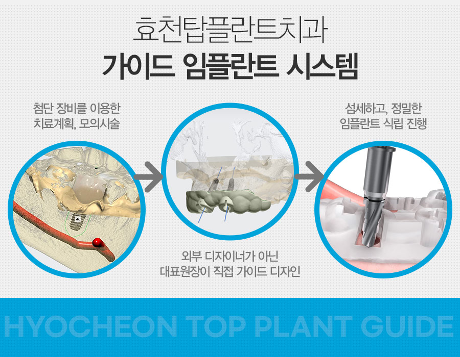 효천탑플란트치과 가이드 임플란트 시스템